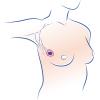 Tumorektómia prsníkov